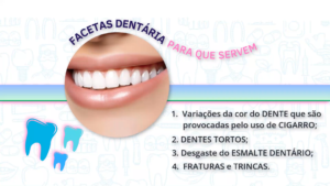 Fct001_O que são Facetas Dentárias