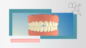 Fct004_Correção com Facetas