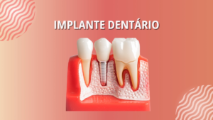 Imp011_Efeitos do Implante em sua vida