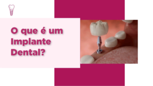 Imp001_O que é um implante dental.
