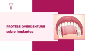 Imp005_Overdenture