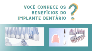 Imp010_Os 5 benefícios do implante
