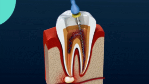 vídeo de tratamento de canal