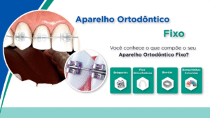Ort002_Aparelho Ortodôntico fixo